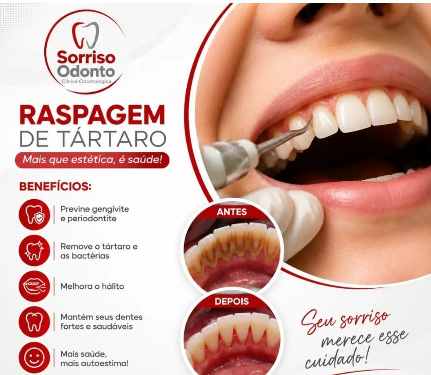Publicação: raspagem de tártaro e seus benefícios